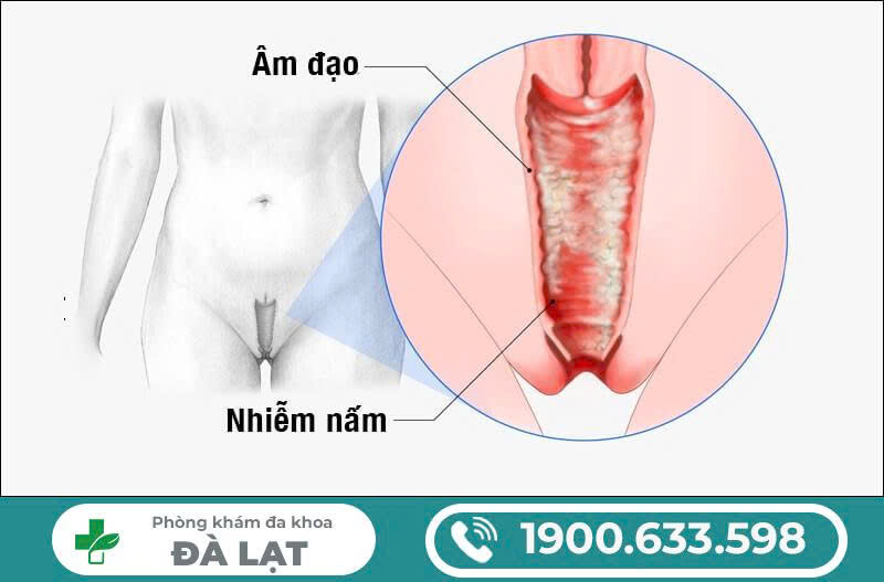 Hình ảnh minh họa