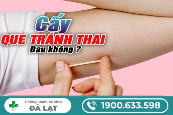 Hình ảnh minh họa